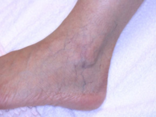 レッグベイン症例