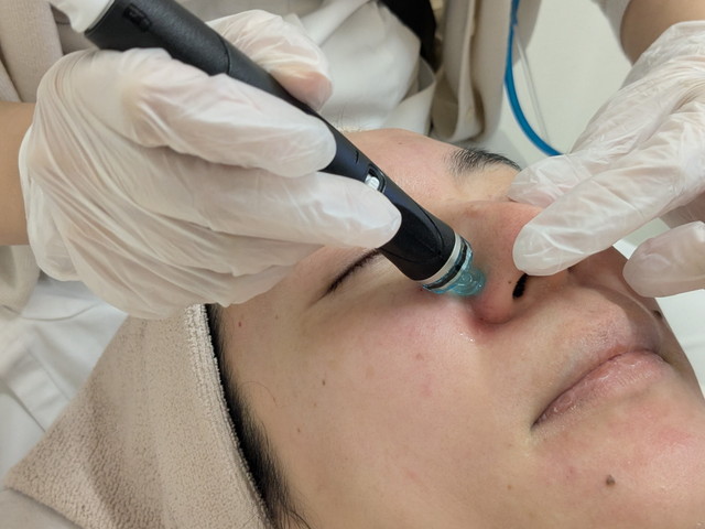 ハイドラフェイシャル